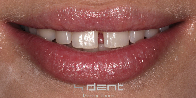 Invisalign metamorfoza przed 4dent 56